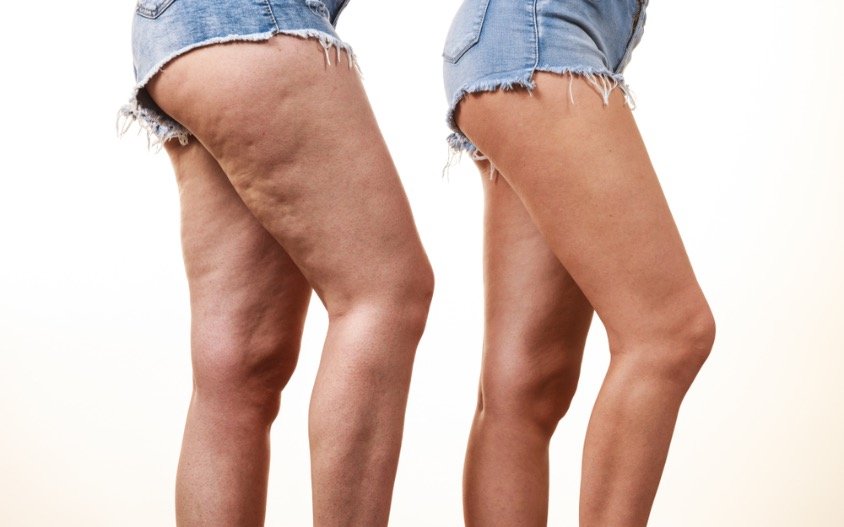 Workshop Online: Celulitis: Mitos, causas y soluciones reales